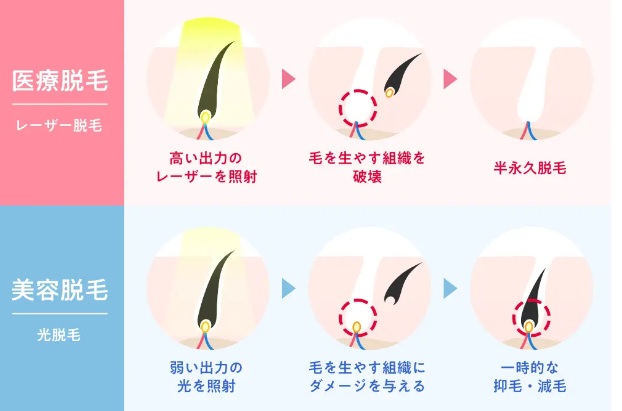 医療脱毛と美容脱毛の違いをあらわす画像