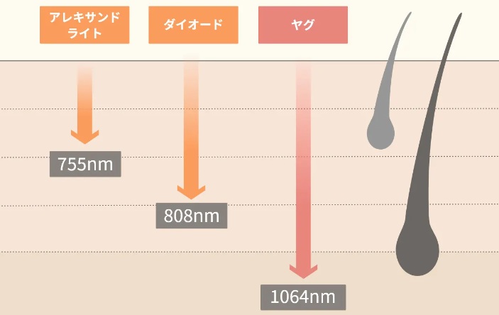 医療脱毛で使用される3種のレーザーの画像